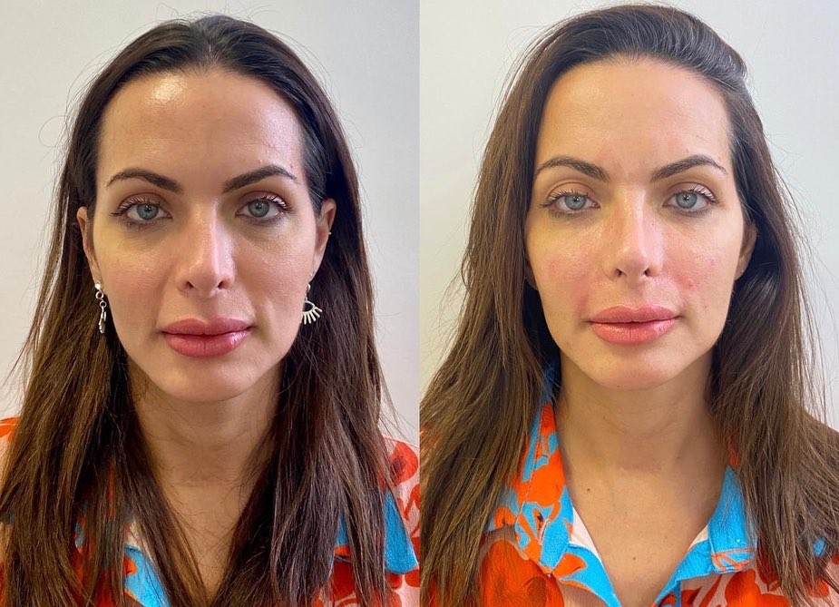 Carla Prata realiza procedimentos estéticos no rosto e exibe antes e depois