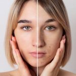 MELASMA: como tratar as manchas na pele e evitar que elas se intensifiquem ao longo da vida