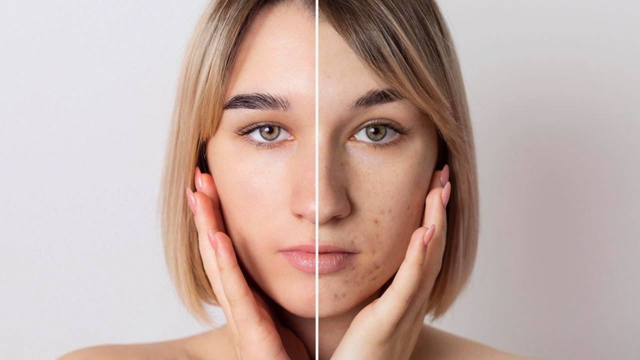 MELASMA: como tratar as manchas na pele e evitar que elas se intensifiquem ao longo da vida